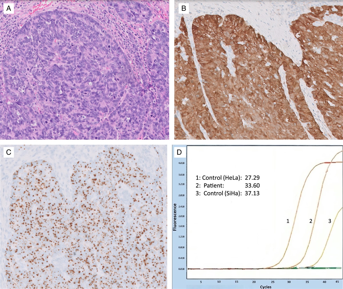 Reappraisal of p16 for Determining HPV Status of Head and Neck Carcinomas Arising in HPV Hotspots