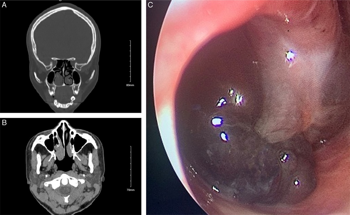 Sinonasal Melanotic PEComa With NONO::TFE3 Fusion: A Case Report and Letter to the Editor