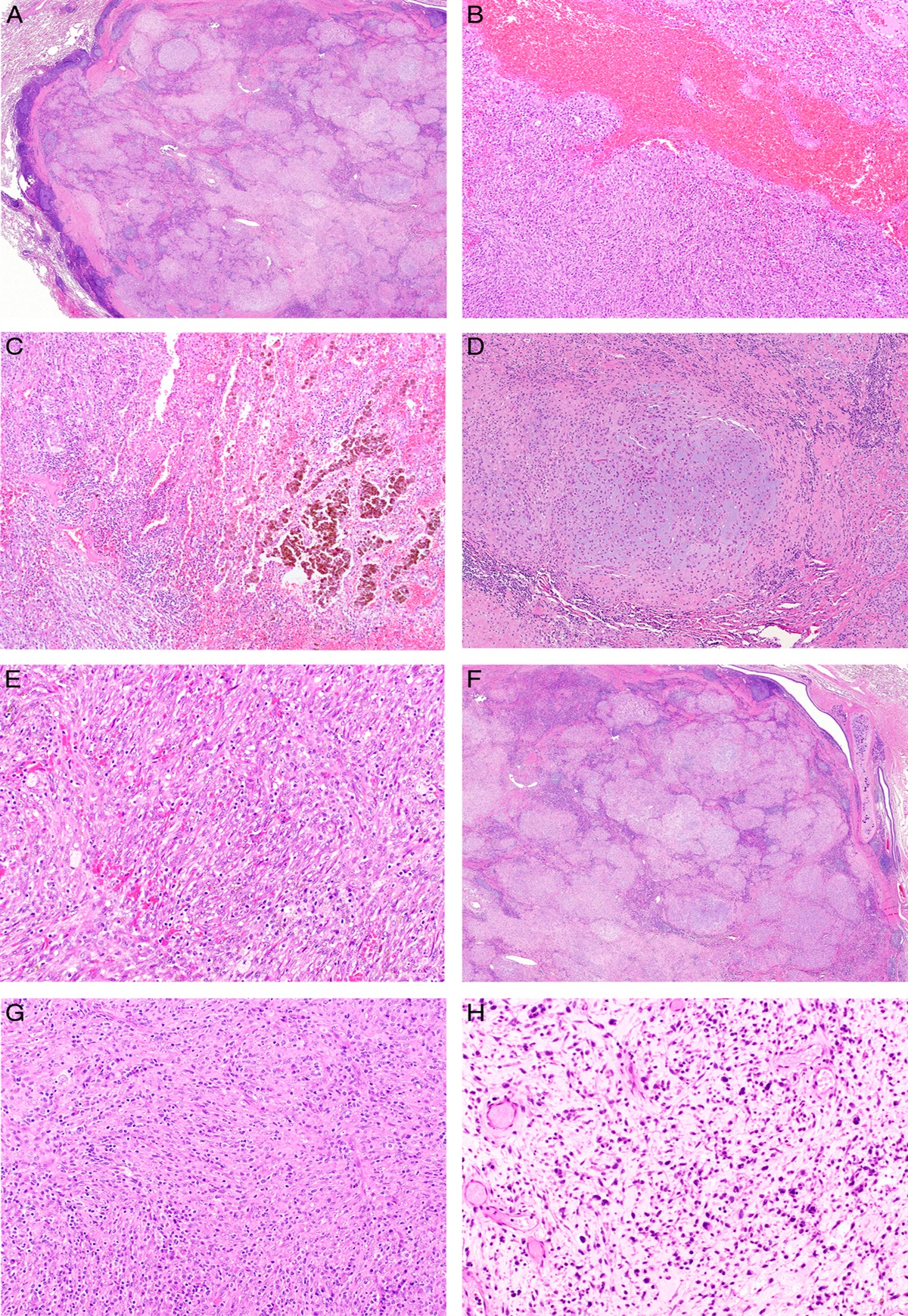 Primary Pulmonary Myxoid Sarcoma and Thoracic Angiomatoid Fibrous Histiocytoma: Two Sides of the Same Coin?
