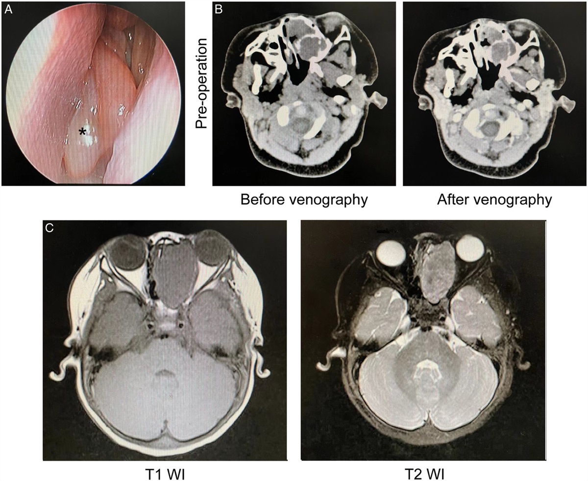 Pathogenic Somatic Mutation of DICER1 and Clinicopathological Features in Nasal Chondromesenchymal Hamartomas: A Series of Nine Cases