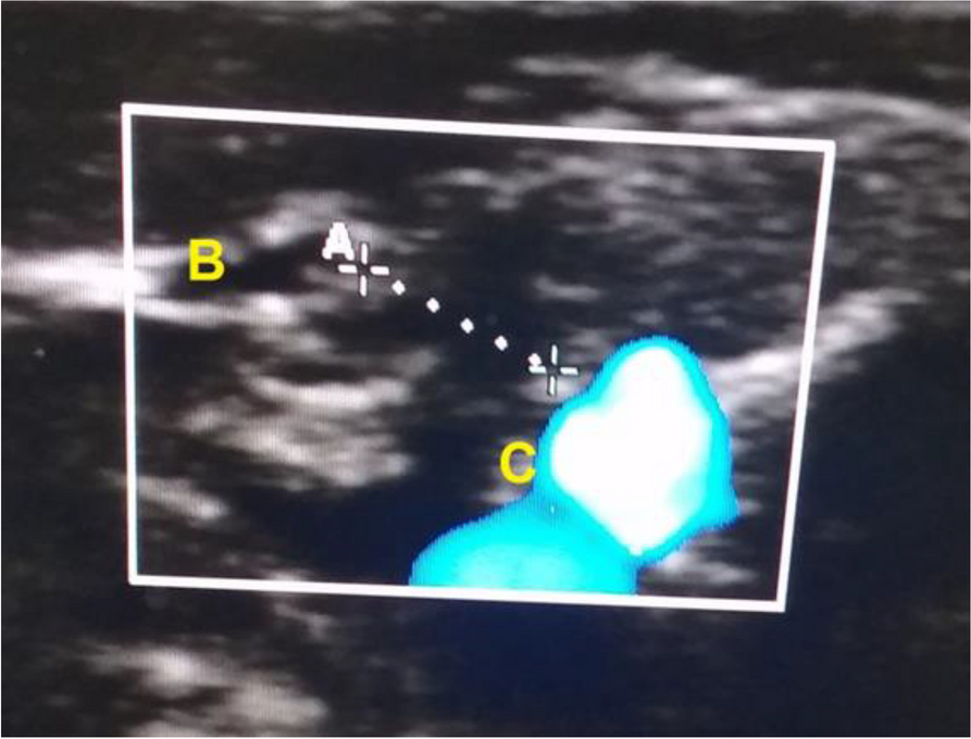 Accuracy of ultrasonography in predicting contralateral patent processus vaginalis compared with laparoscopic findings in children