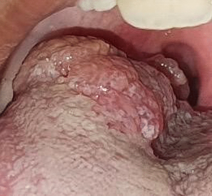 Angiokeratoma of tongue in the pediatric age group: a rare presentation