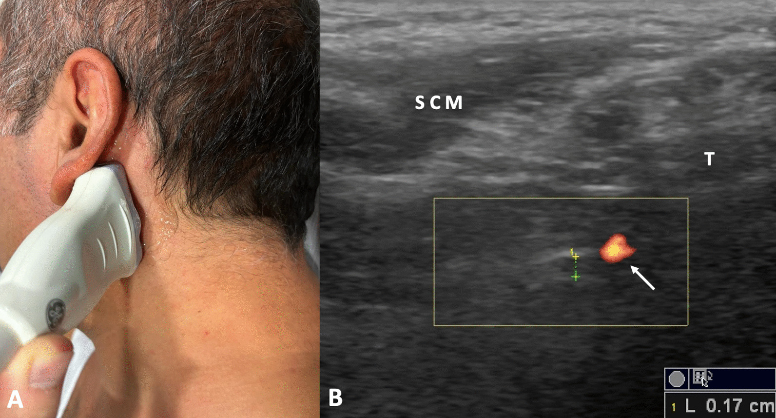 Ultrasonography in Bell’s Palsy: seeing the nerve rather than trialing on the muscles