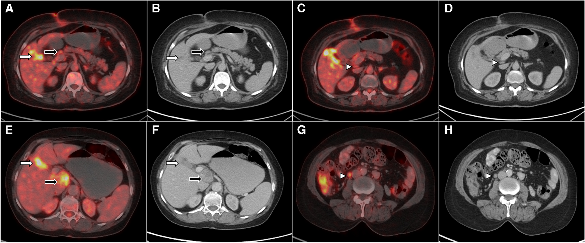 Incidentally Detected Gallbladder Carcinoma: Can F-18 FDG PET/CT Aid in Staging and Prognostication?