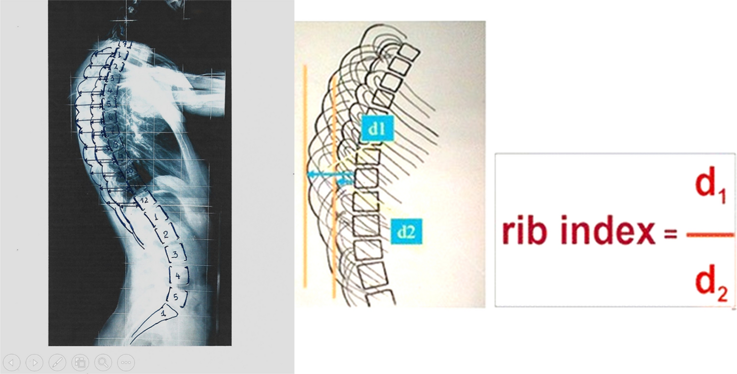 Rib index is a strong surrogate of scoliometric reading in idiopathic scoliosis