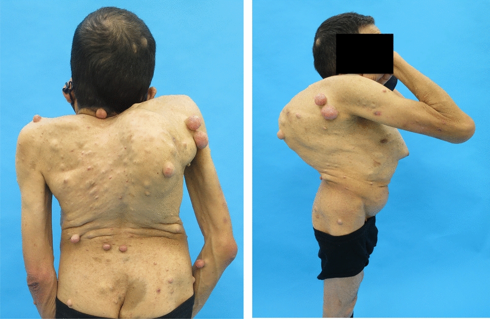 Surgical management of omega deformity in a patient with neurofibromatosis type 1: a case report