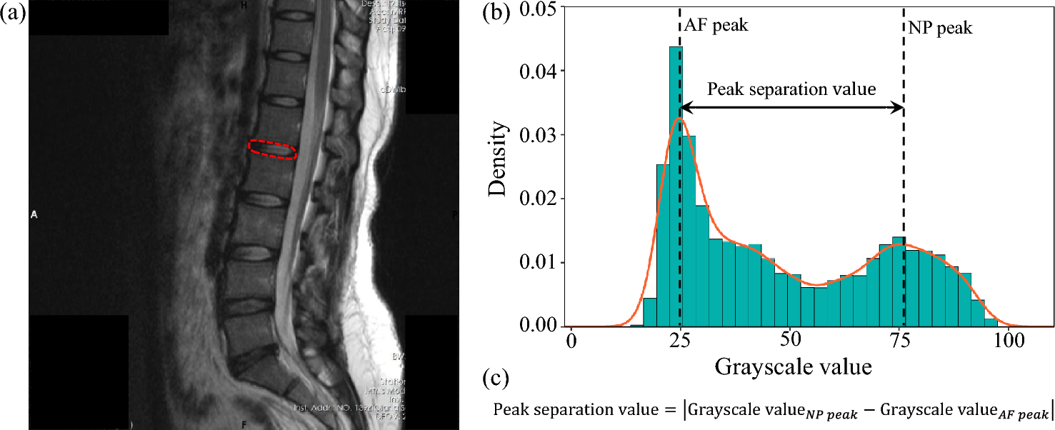 A novel quantitative method to evaluate lumbar disc degeneration: MRI histogram analysis