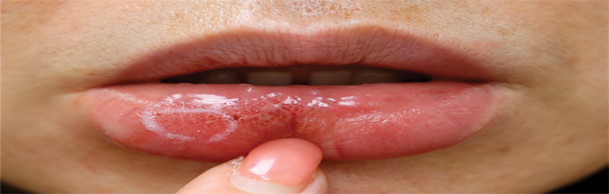 Multiple, Grouped Translucent Papulovesicles on the Lower Lip: Challenge