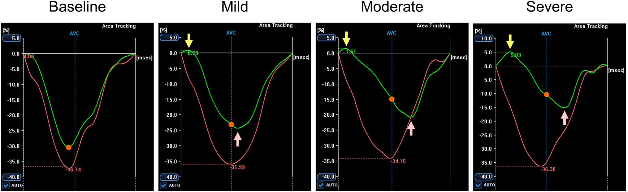 Myocardial motion in acute ischemia: revealing invisible deformation by echocardiography