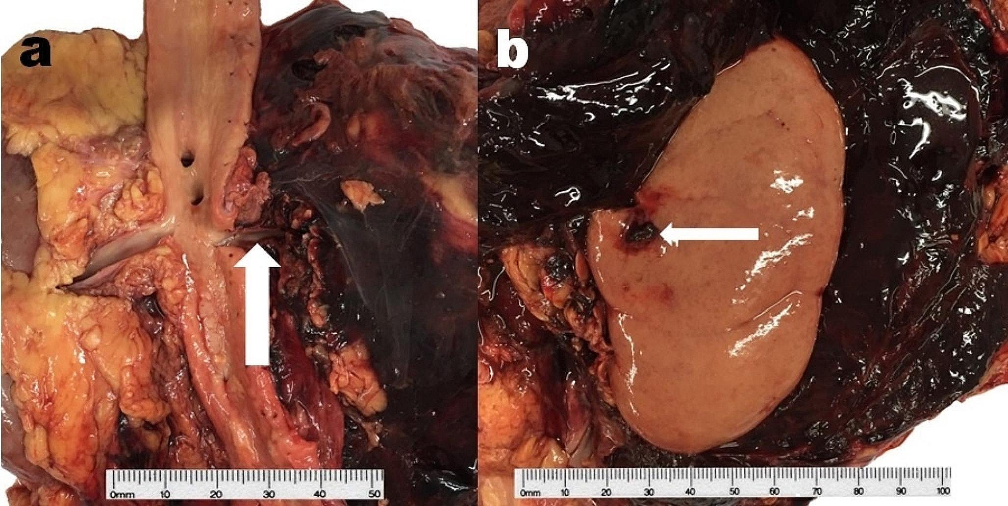A fatal misdiagnosis of page kidney – case report