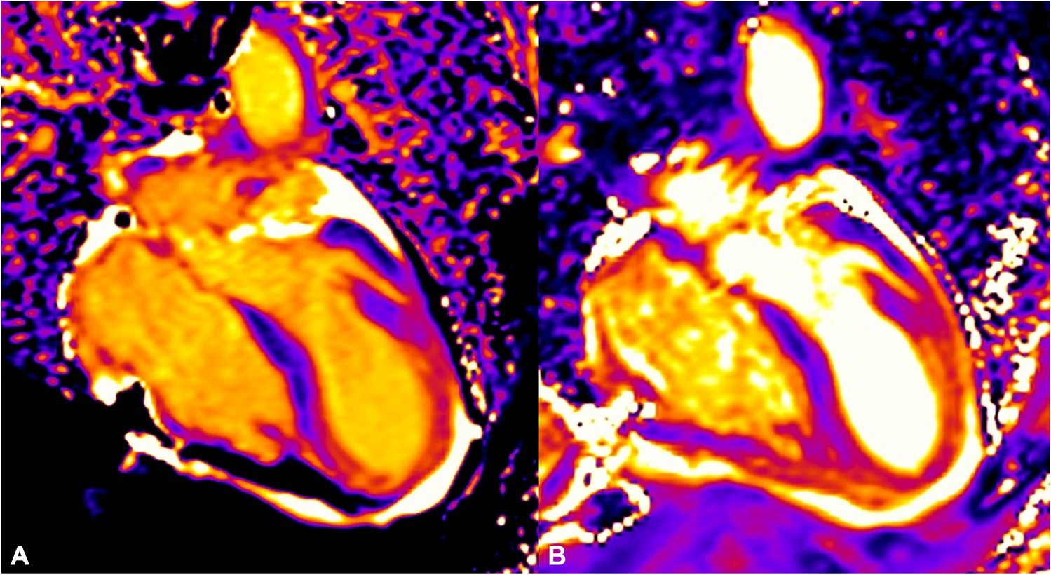Advanced Cardiovascular Magnetic Resonance Imaging in Takotsubo Syndrome: Update on Feature Tracking and Tissue Mapping