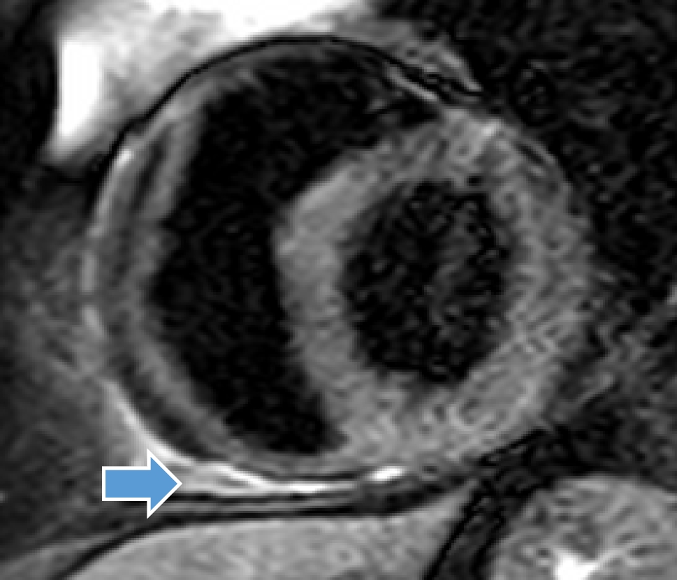 Role of Cardiac MRI in Pericardial Diseases
