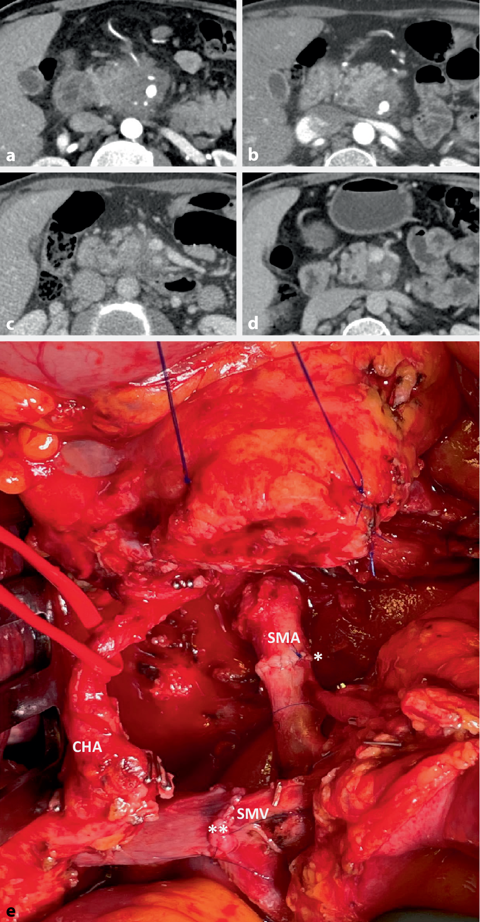Intraoperative strategies and techniques to achieve surgical radicality in pancreatic cancer