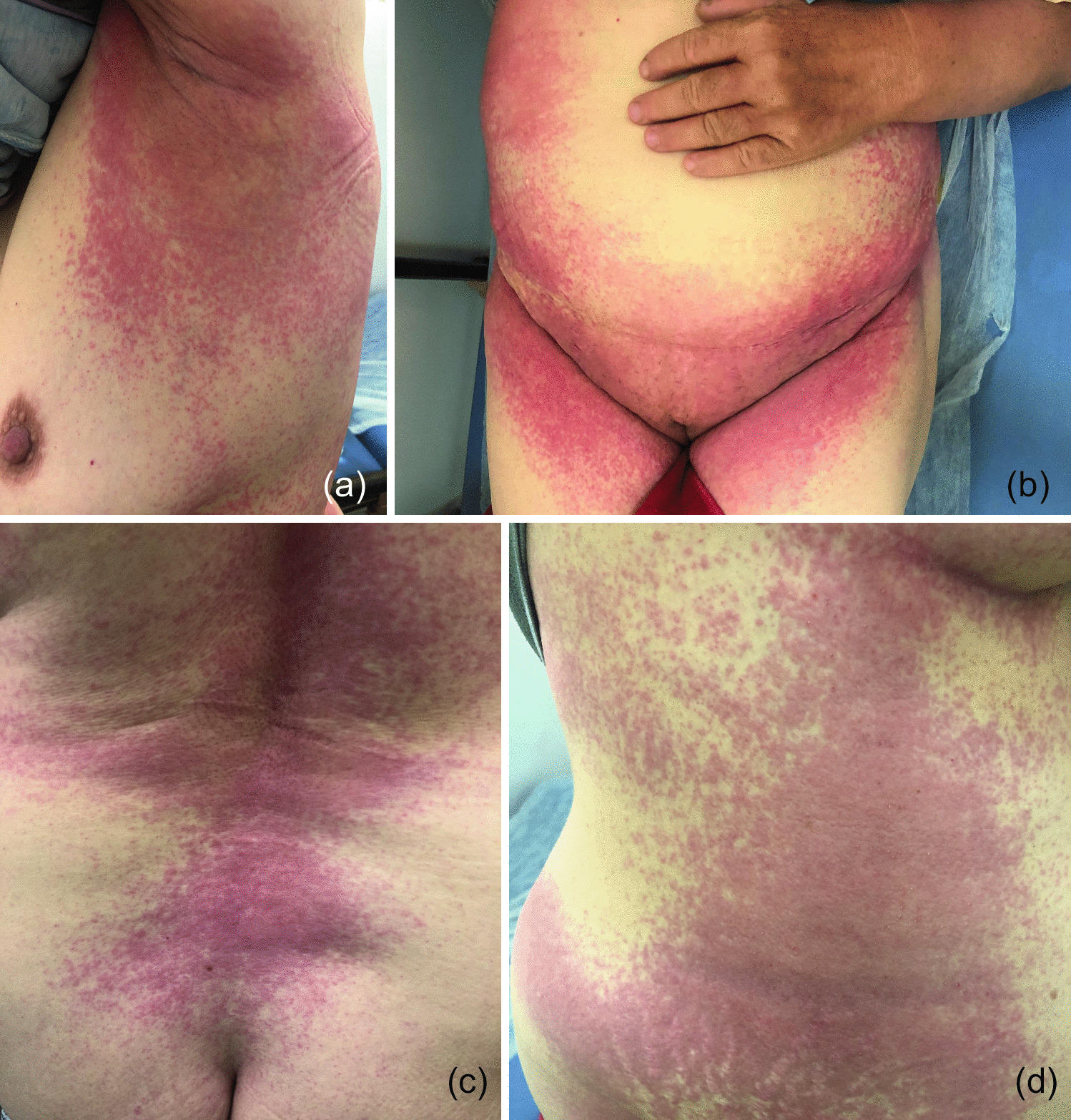 Symmetrical Drug-Related Intertriginous and Flexural Exanthem-Like Eruption Post-COVID-19 Vaccination: A Case Report and Review of the Literature