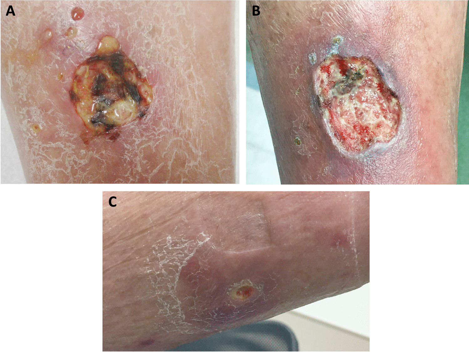 Nontuberculous Mycobacterial Infections and Management for the Inpatient Dermatologist