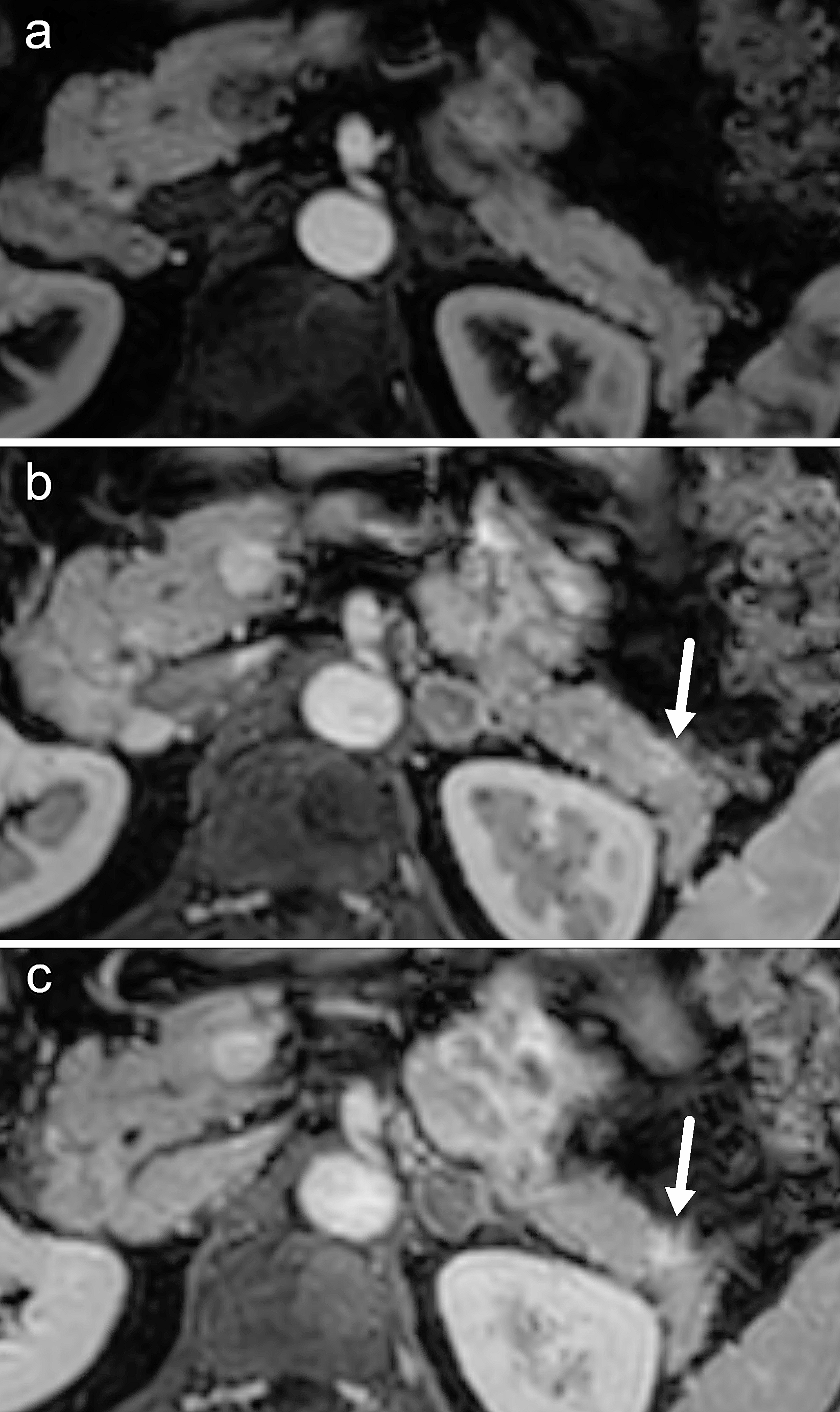 Screening for pancreatic cancer in high-risk individuals using MRI: optimization of scan techniques to detect small lesions