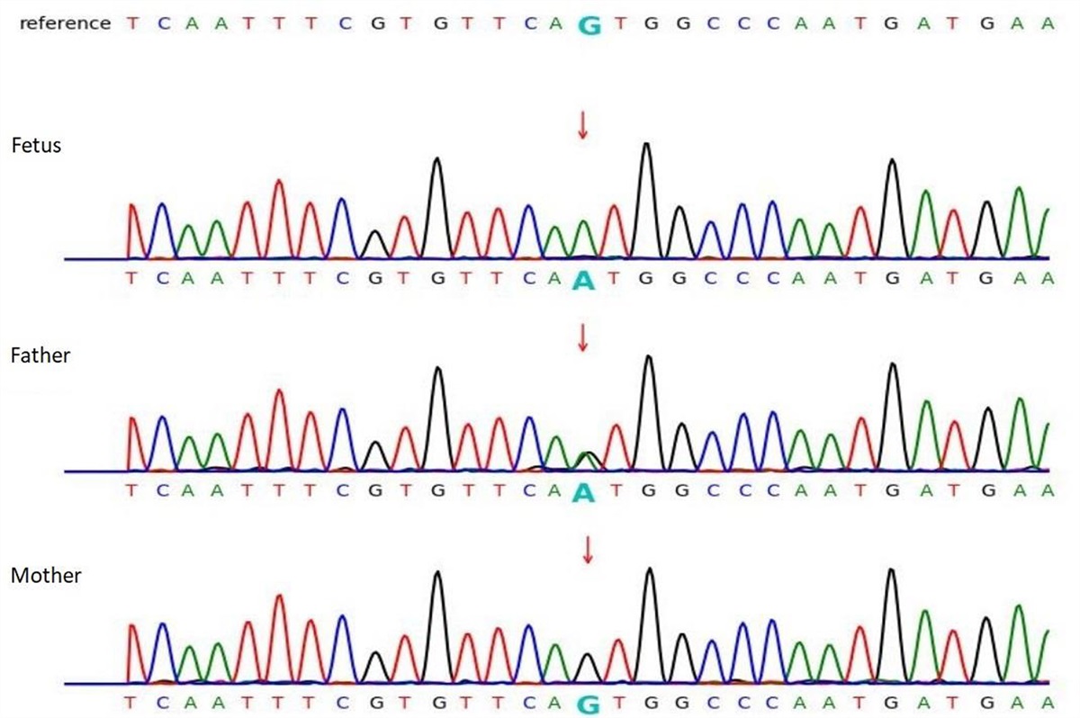 Whole-exome-based single nucleotide variants and copy number analysis for prenatal diagnosis of compound heterozygosity of SMPD4