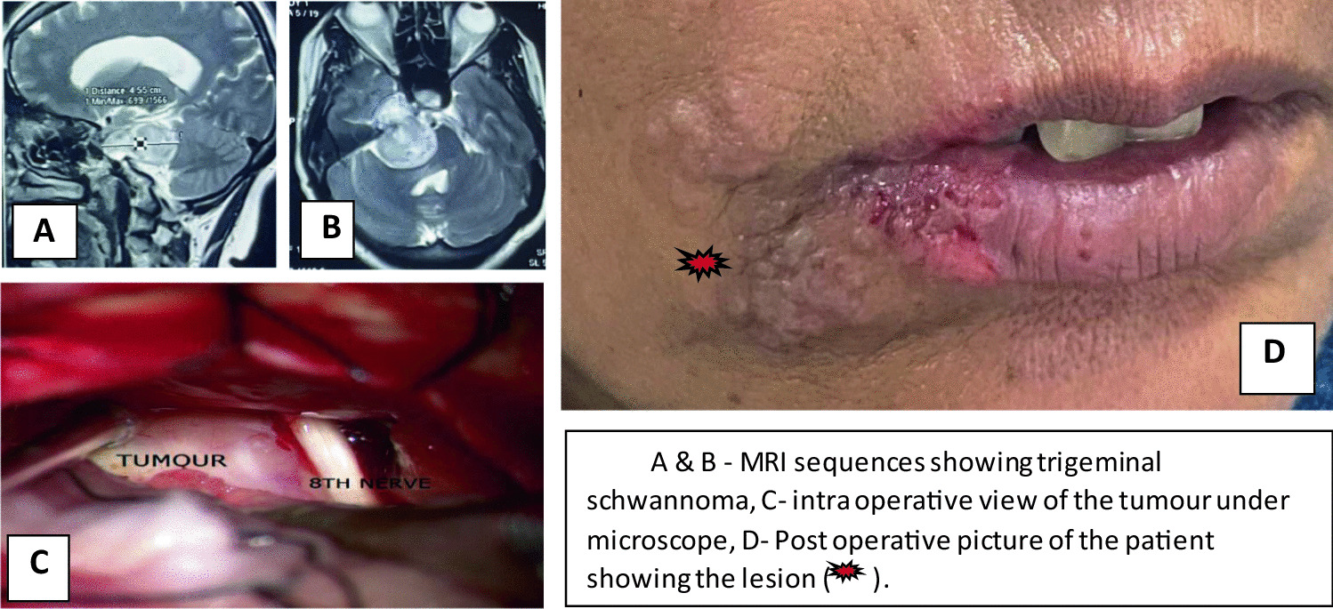 Reactivation of varicella zoster virus following trigeminal schwannoma resection