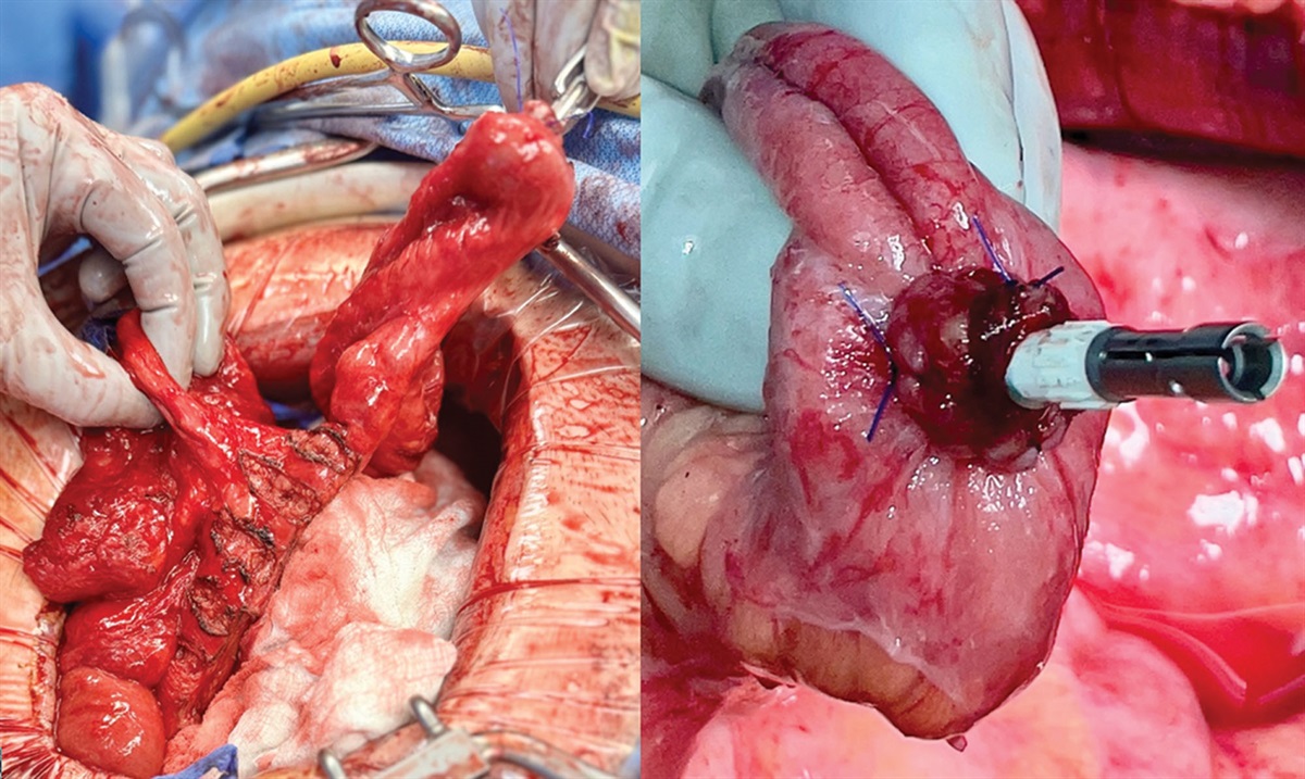 Ileoanal Pouch Construction for IBD