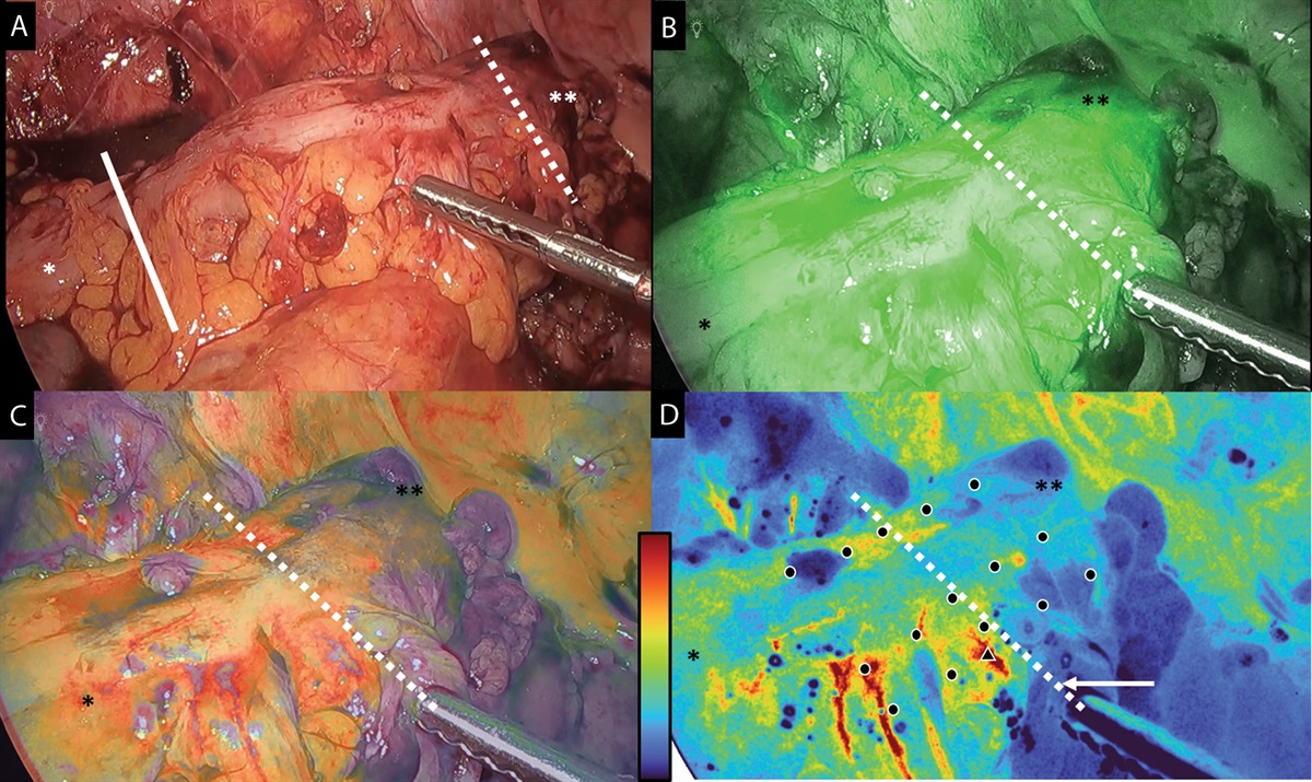 Clinical Utility of Laser Speckle Contrast Imaging and Real-Time Quantification of Bowel Perfusion in Minimally Invasive Left-Sided Colorectal Resections