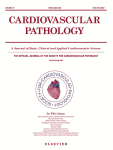 Aortic valve fibroelastoma presenting with myocardial infarction with non-obstructive coronary arteries (MINOCA): A case report and review of the literature