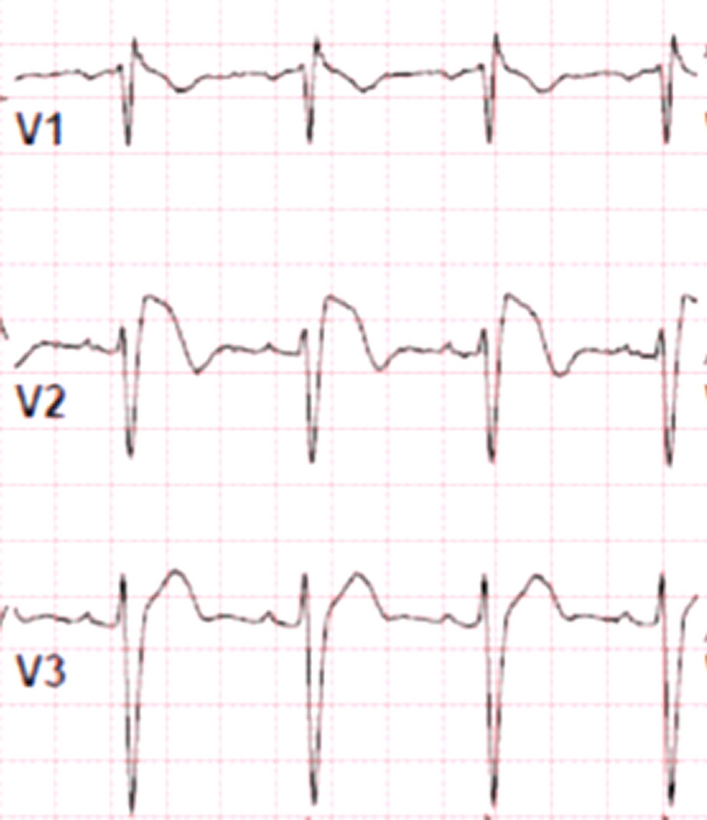 Brugada syndrome: a review and the role of epicardial ablation in management