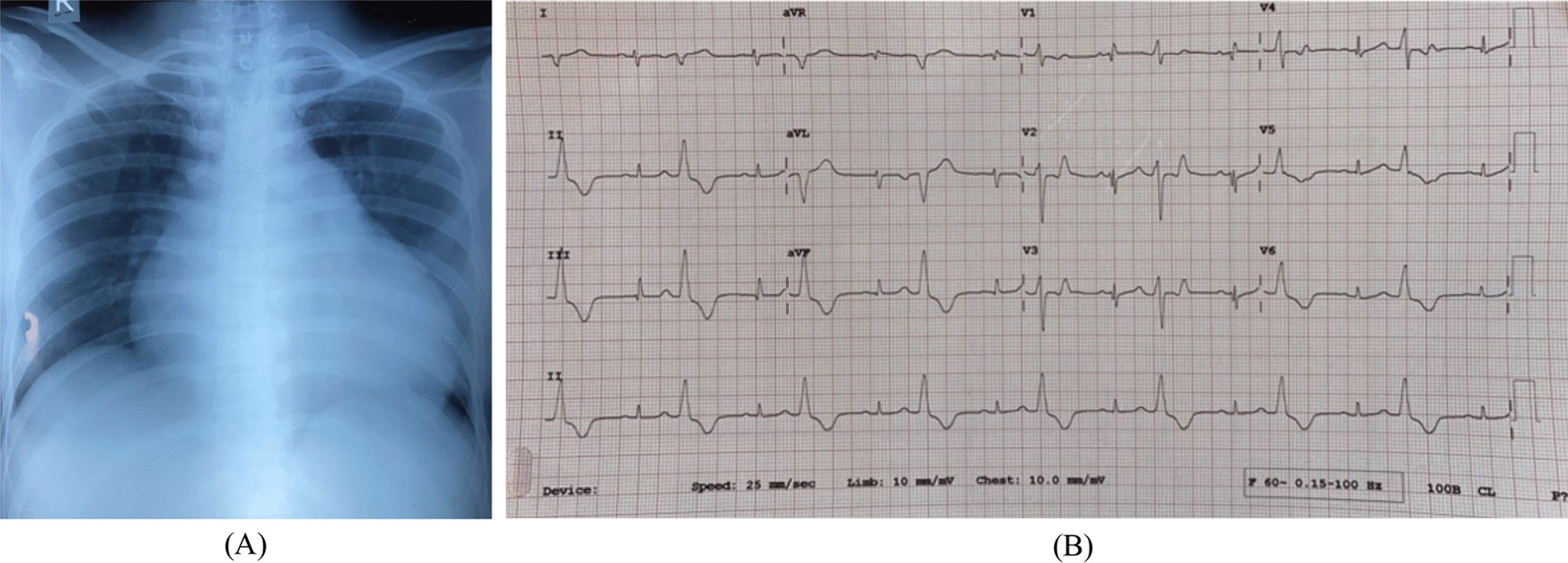 Isolated rheumatic tricuspid valve regurgitation: it is only rare not just a myth: rare case report