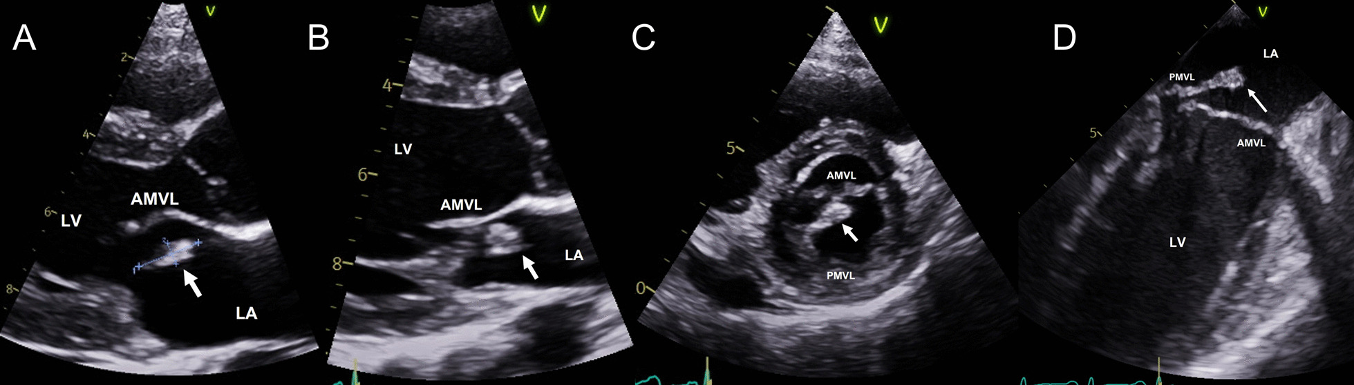 An unusual presentation of subacute Haemophilus parainfluenzae endocarditis in a low-risk woman treated by minimally invasive mitral valve repair: a case report