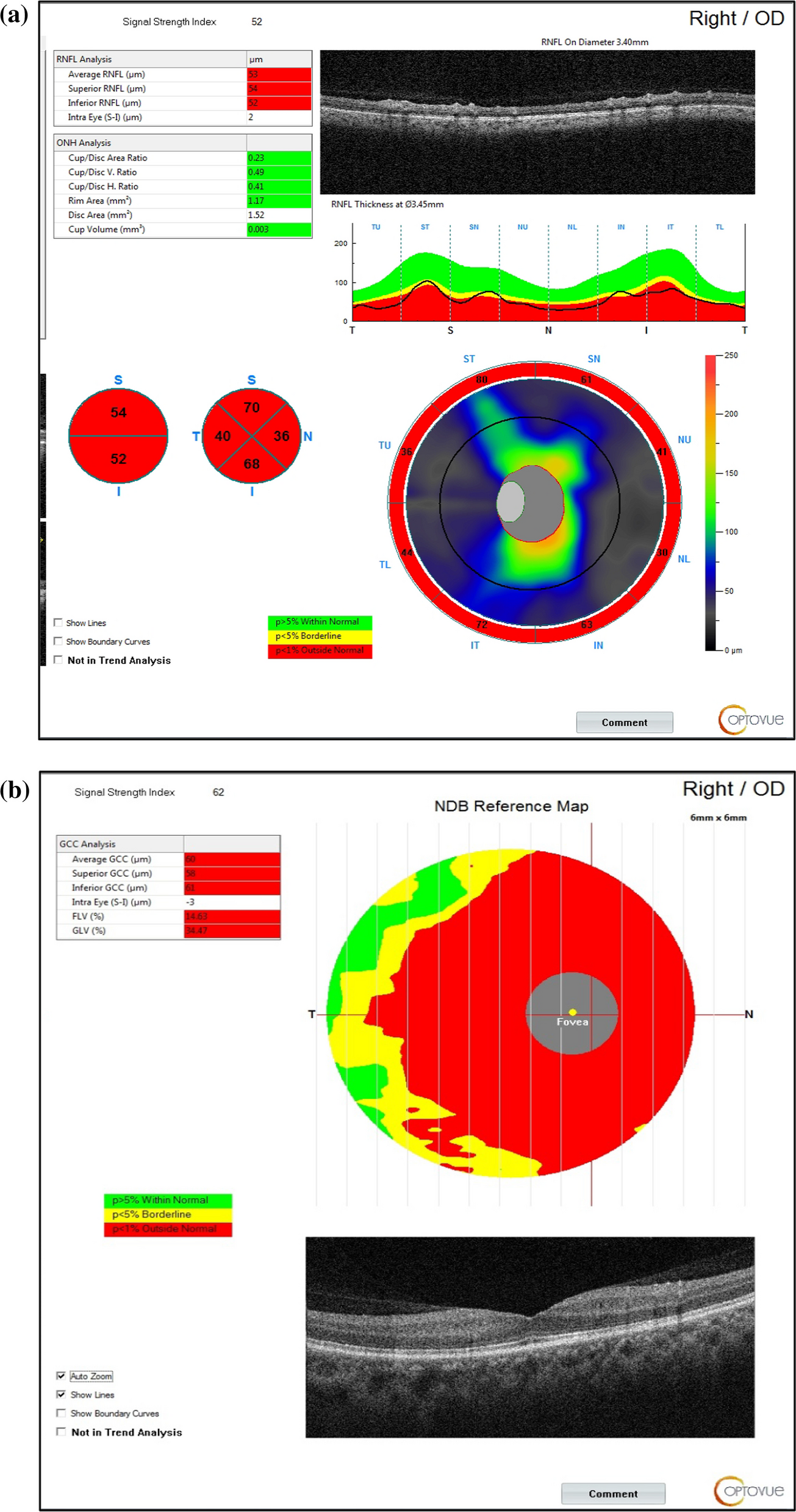 Unveiling the retinal secrets of neuromyelitis optica spectrum disorder