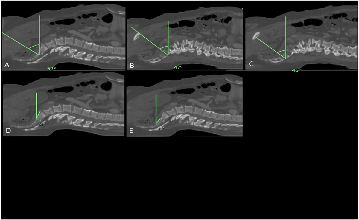 Incidence of Suboptimal Fluoroscopic Outlet Imaging of the Sacrum and Pelvic Retroversion Necessary for Optimal Views