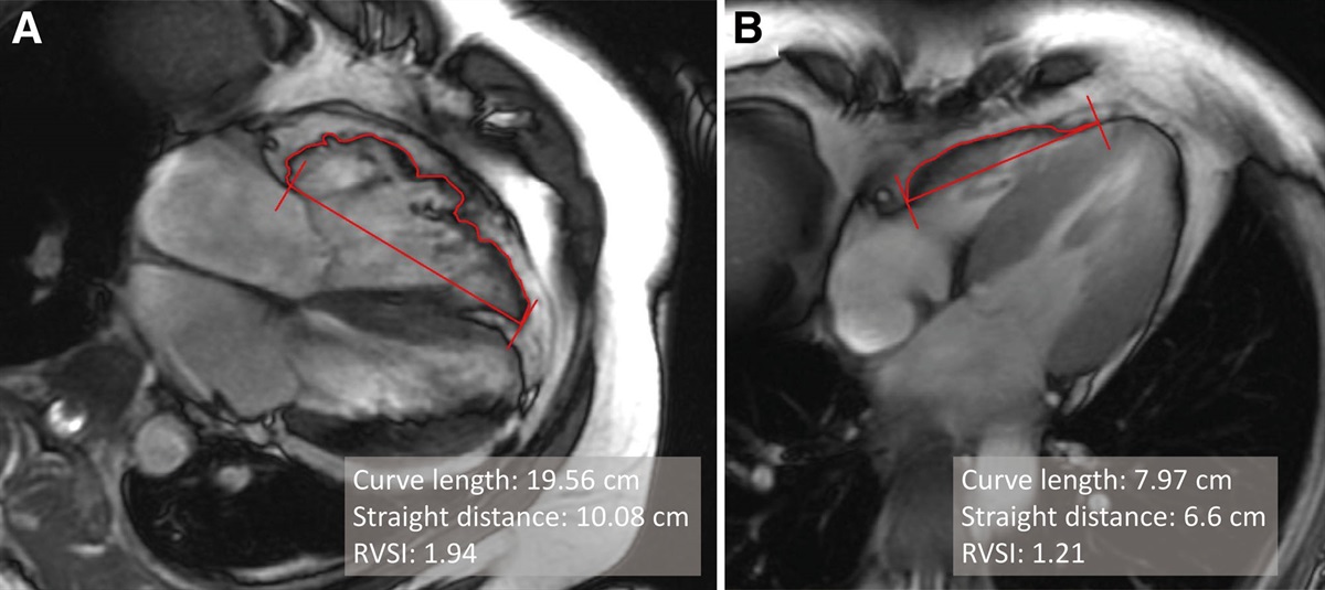 Right ventricular scalloping index as cardiac magnetic resonance-derived marker for diagnosis of arrhythmogenic right ventricular cardiomyopathy