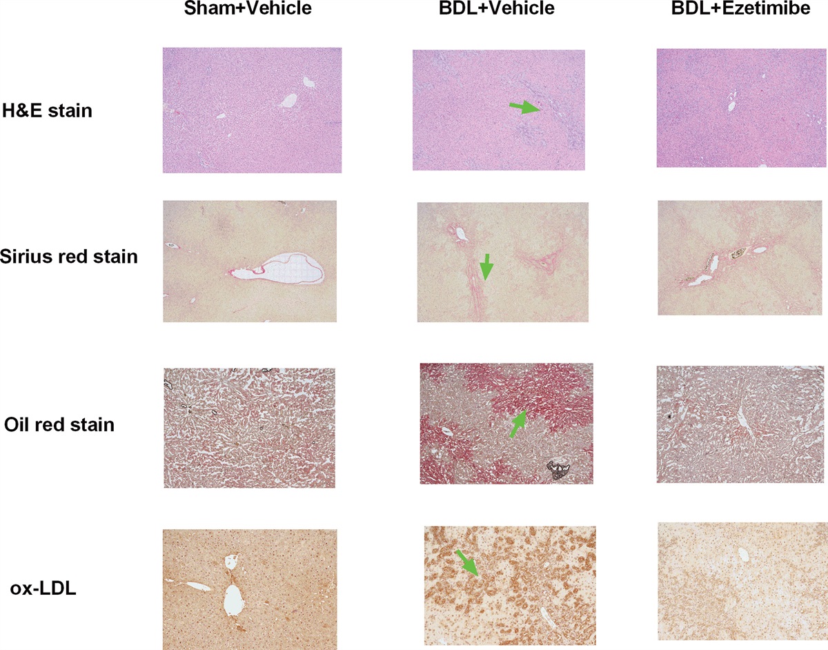 Ezetimibe treatment reduces oxidized low-density lipoprotein in biliary cirrhotic rats