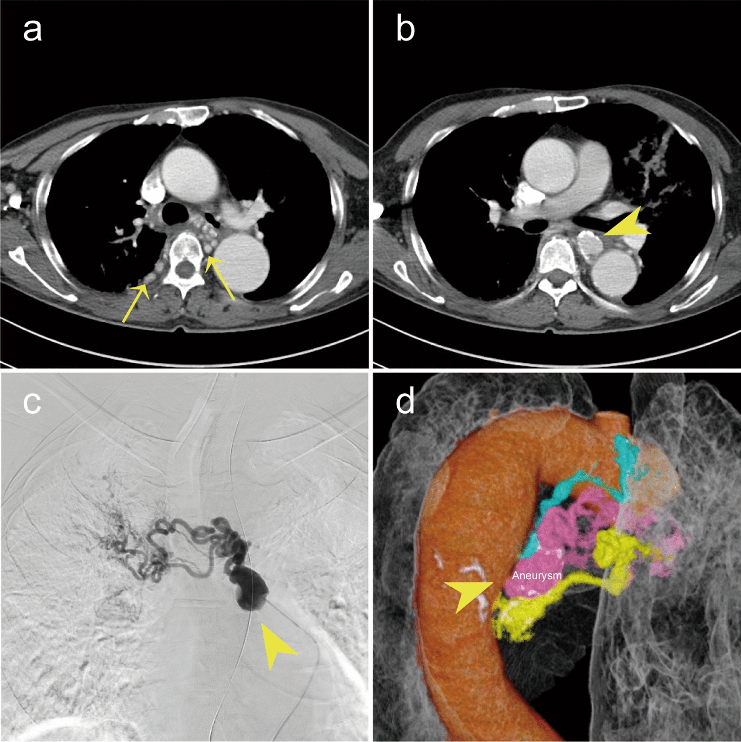 Bronchial arterial embolization for an unruptured bronchial artery aneurysm in patient with hemoptysis