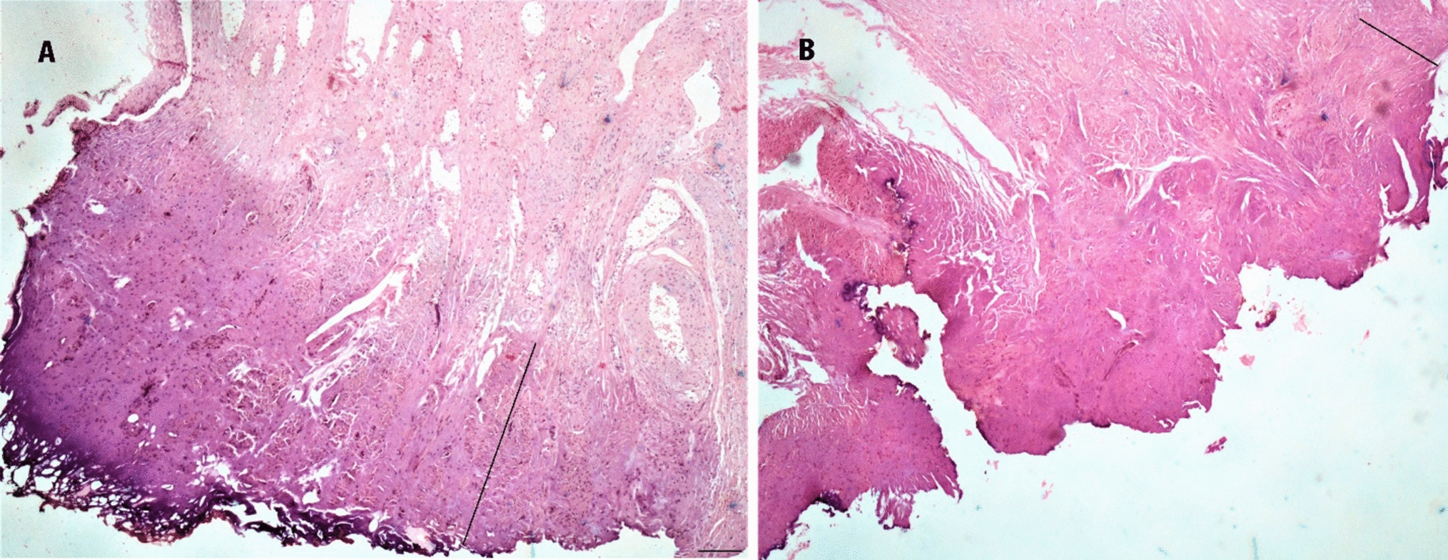 Comparing Thermal Damage Using Monopolar Hook Versus Harmonic Scalpel in Total Laparoscopic Hysterectomy; A Double-Blind Randomized Controlled Trial