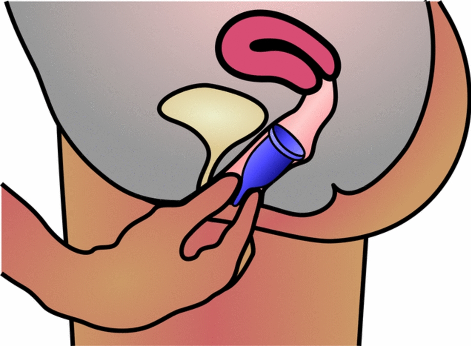 Uptake and Adherence to Using a Menstrual Cup for Managing Menstruation Among Women in Rural Areas of India