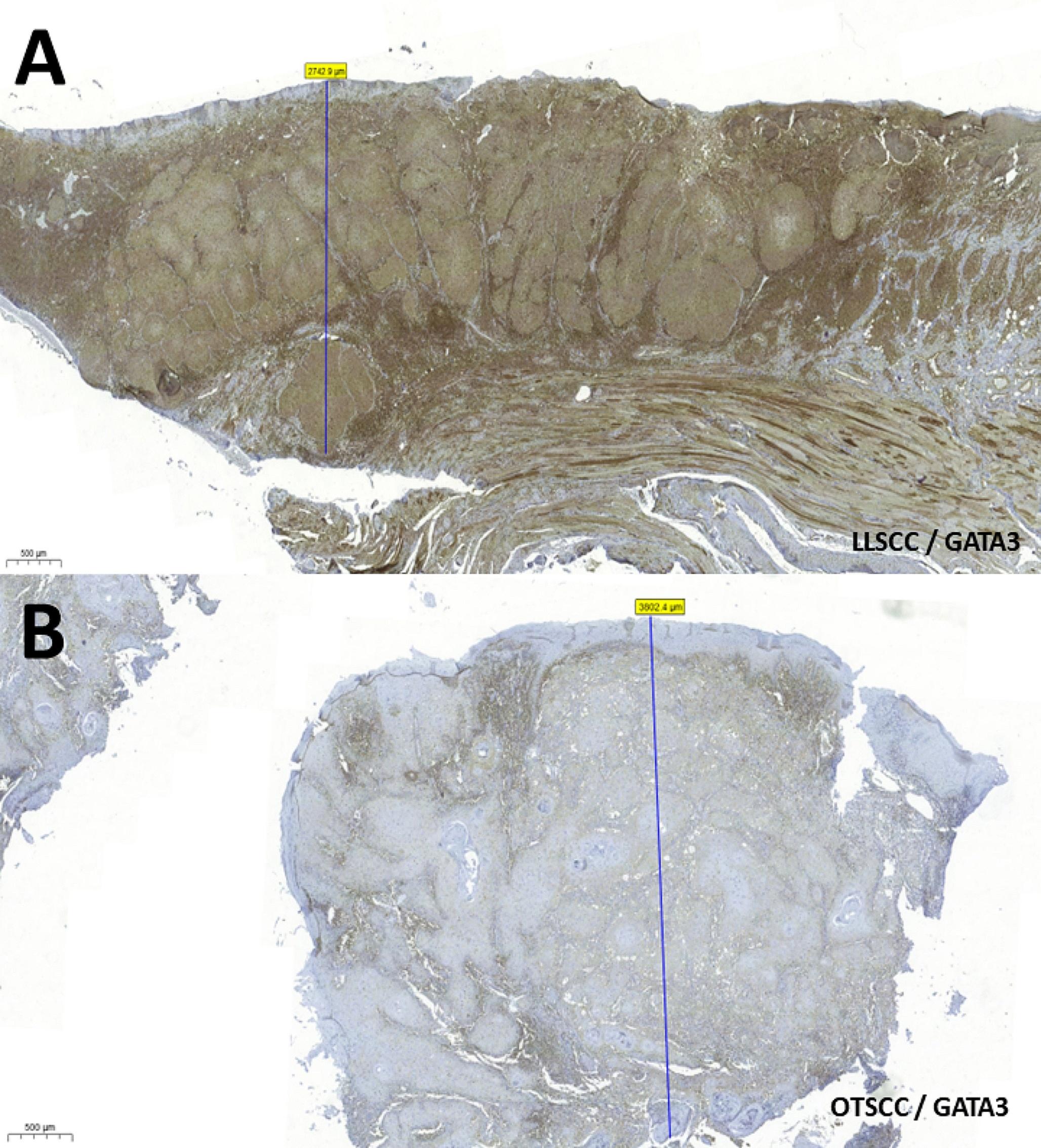 Relationship between tumor thickness and GATA3 immunoexpression in lip and tongue squamous cell carcinomas