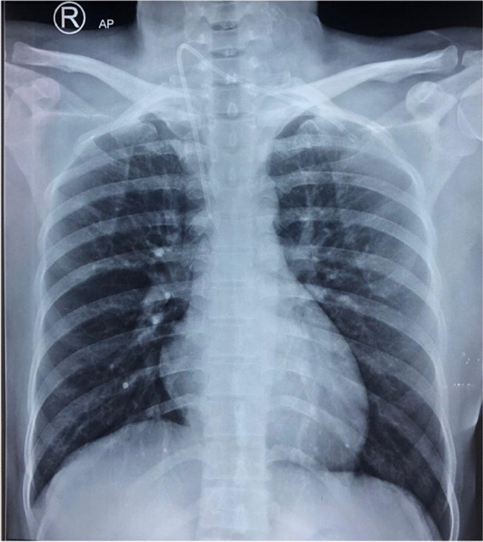 Cardiac Migration of Chemoport Catheter—A Rare Complication: Review of Literature and Our Experience