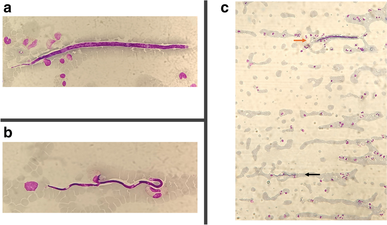 Loa loa and Mansonella perstans infections in non-endemic countries: a narrative review