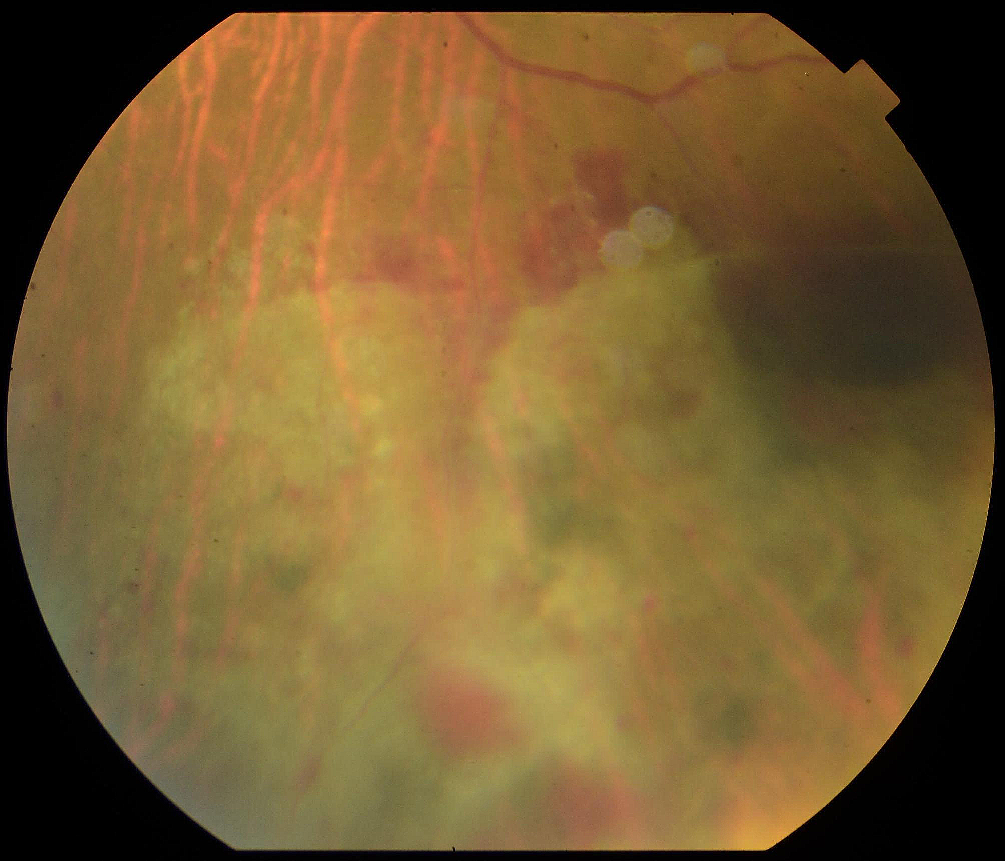 Fluocinolone intravitreal implant (Iluvien) for macular edema secondary to immune recovery uveitis in patient with acute myeloid leukemia