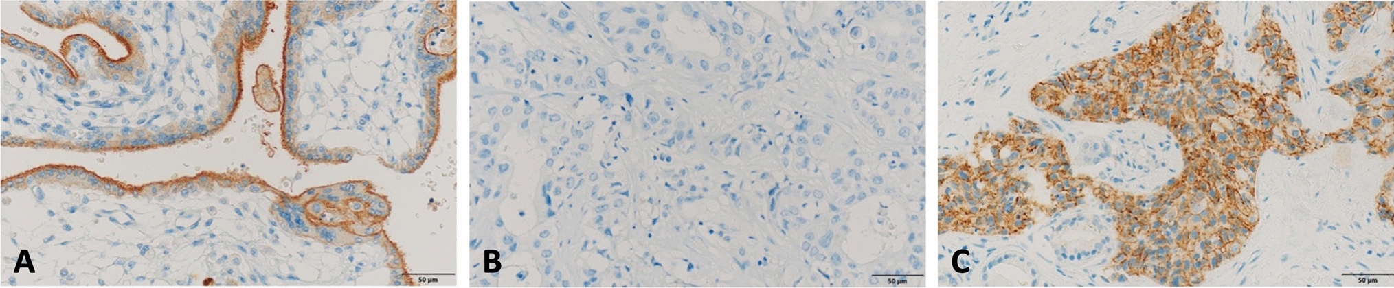 PD-L1 expression and microsatellite instability (MSI) in cancer of unknown primary site