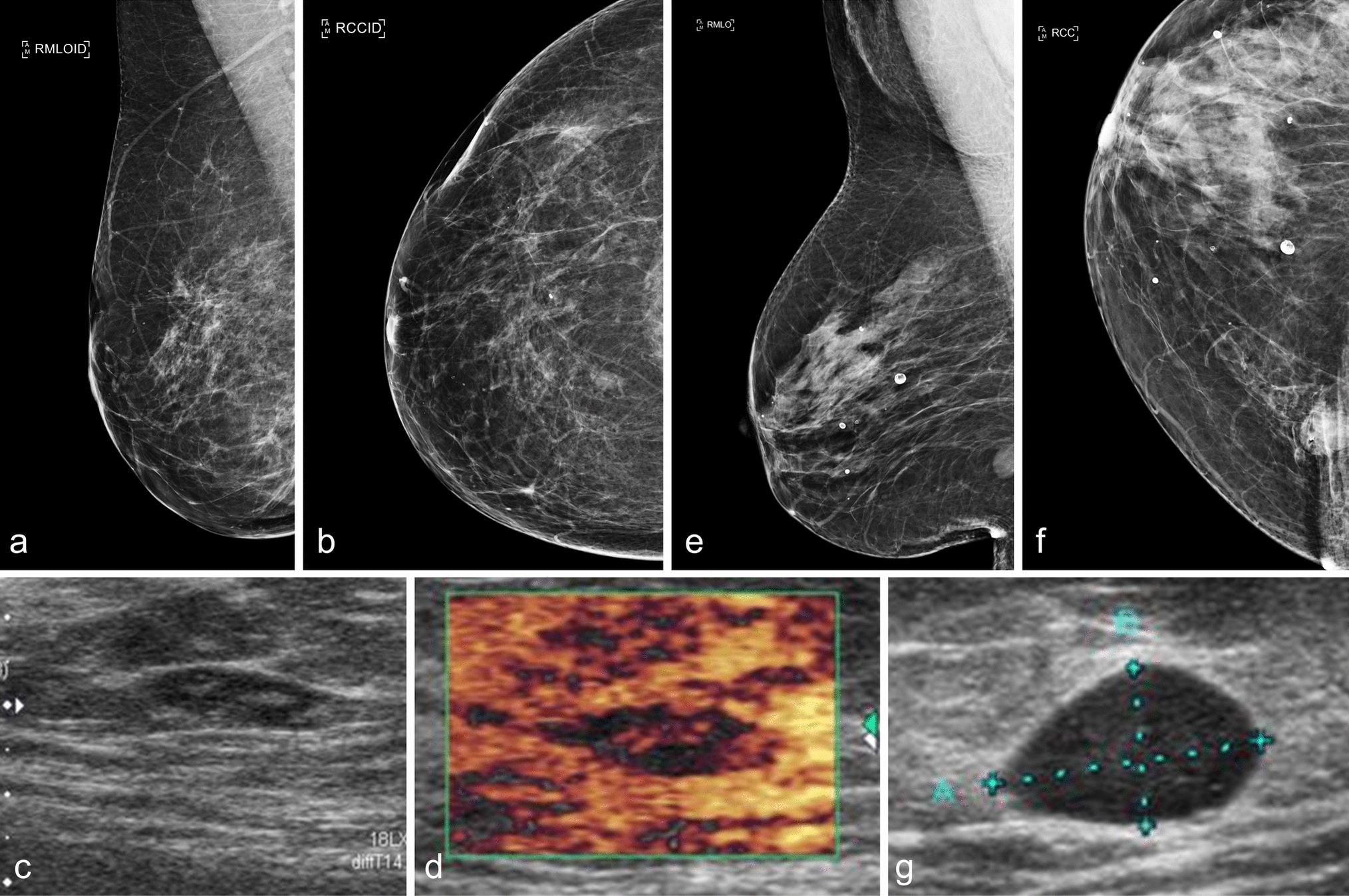 Primary MALT lymphoma of the breast: pathological and radiological characteristics