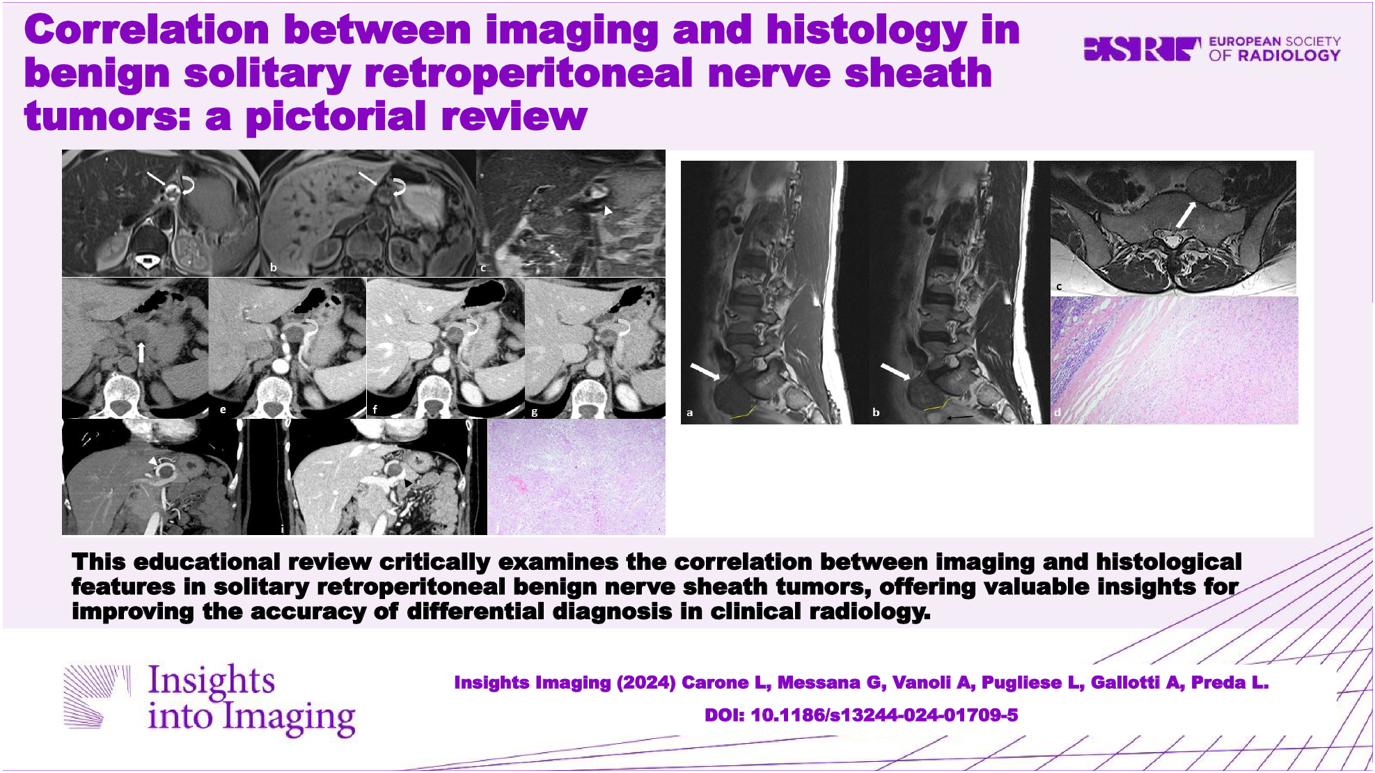 Correlation between imaging and histology in benign solitary retroperitoneal nerve sheath tumors: a pictorial review