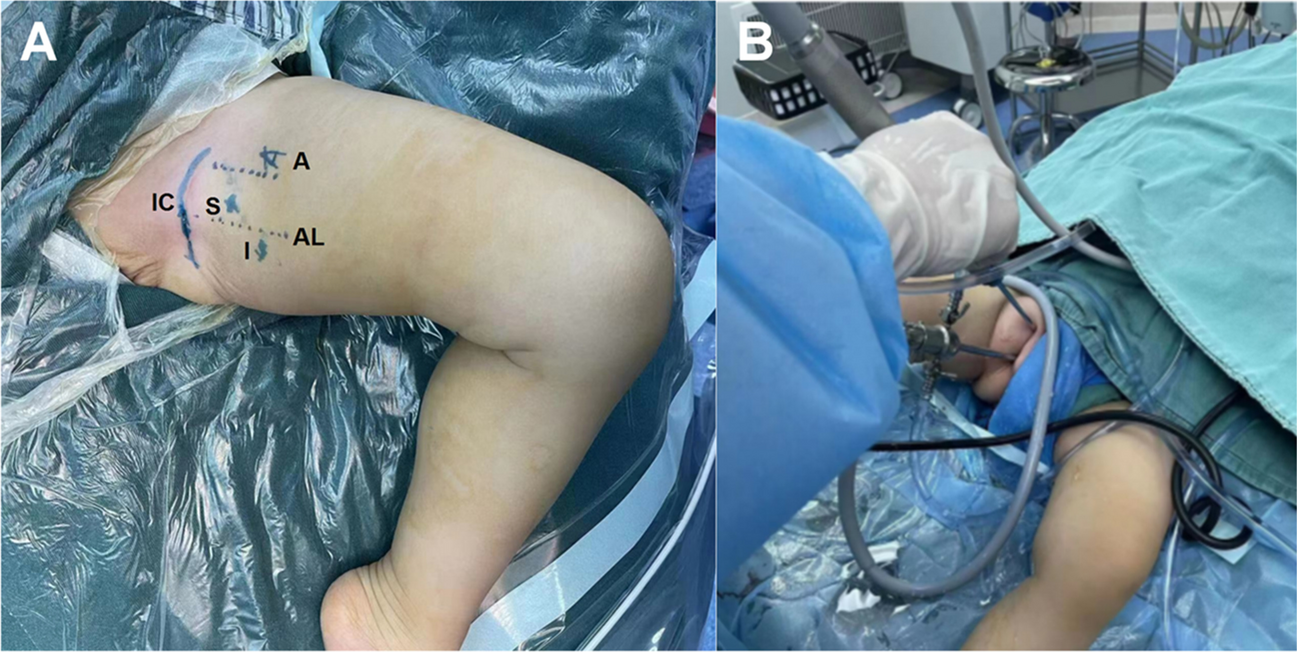 Arthroscopic debridement and reduction is an effective procedure for failed closed reduction in young children with developmental dislocation of the hip