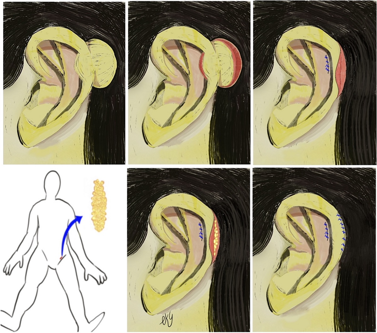 A Novel Method for Patients With Ear Keloid: Enucleation and Fat Grafting