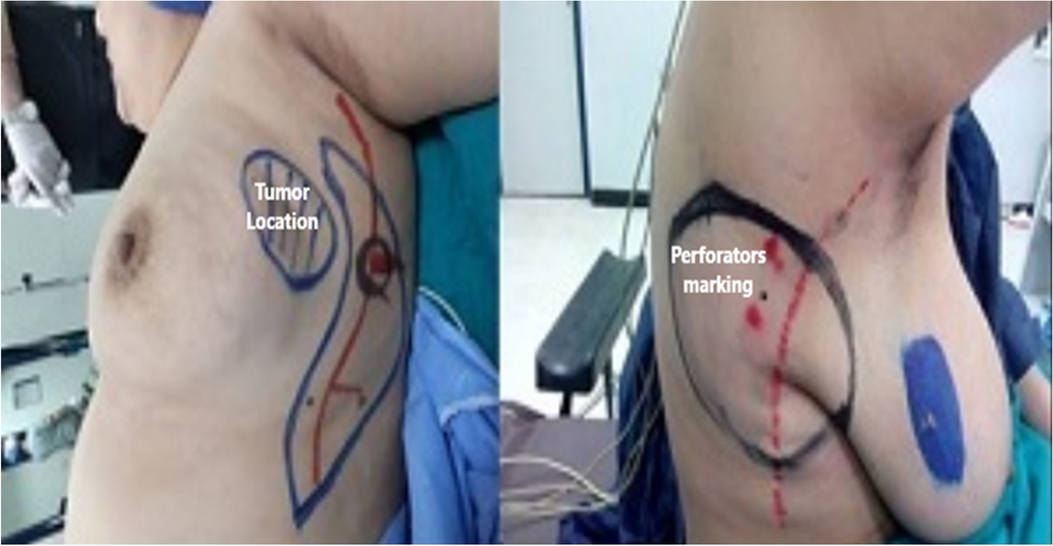 Partial Breast Reconstruction Using Thoracodorsal Flap Based on Anatomically Localized Descending Perforators Without Doppler Ultrasound: A Case Series