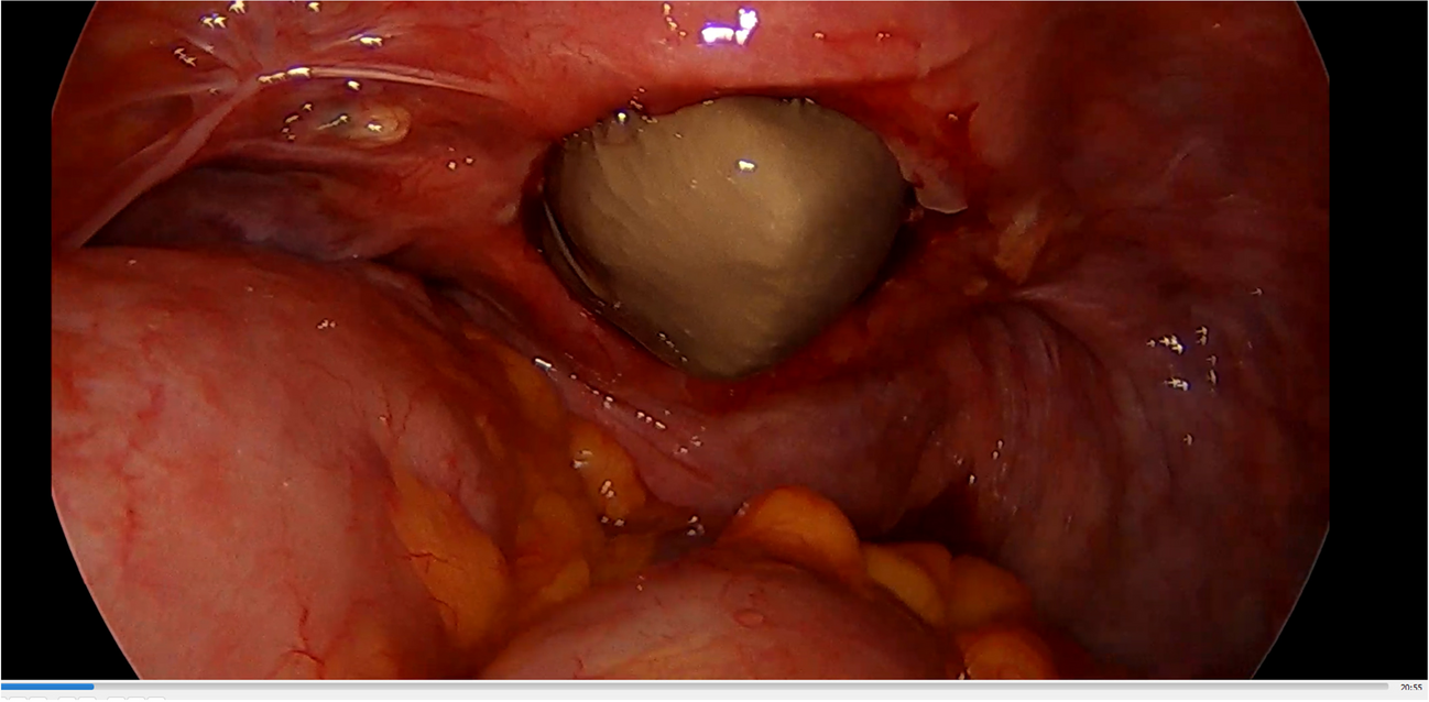 Vaginal Cuff Dehiscence—A Serious But Rare Complication: A Case Report