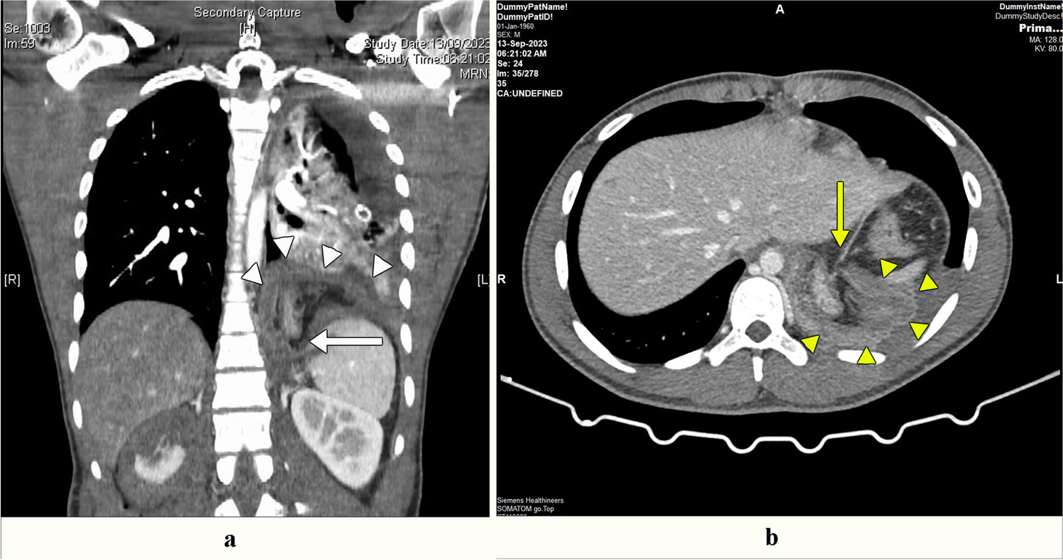 Esophageal Injury Masquerading as Diaphragmatic Injury