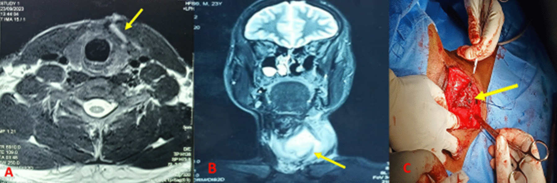 Recurrent Unexplained Neck Abscess Due to 4th Branchial Anomaly