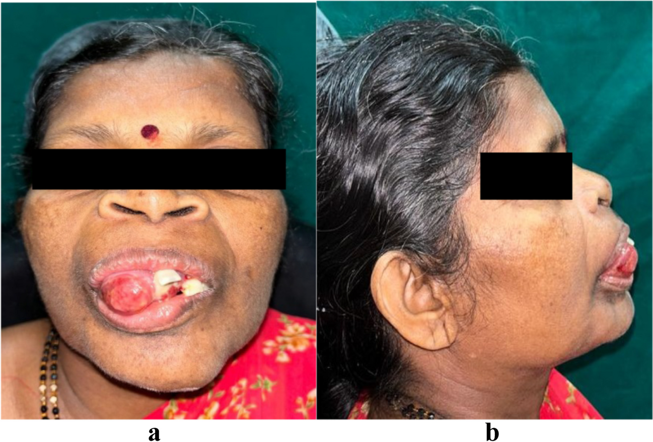 Brown Tumour of the Premaxilla