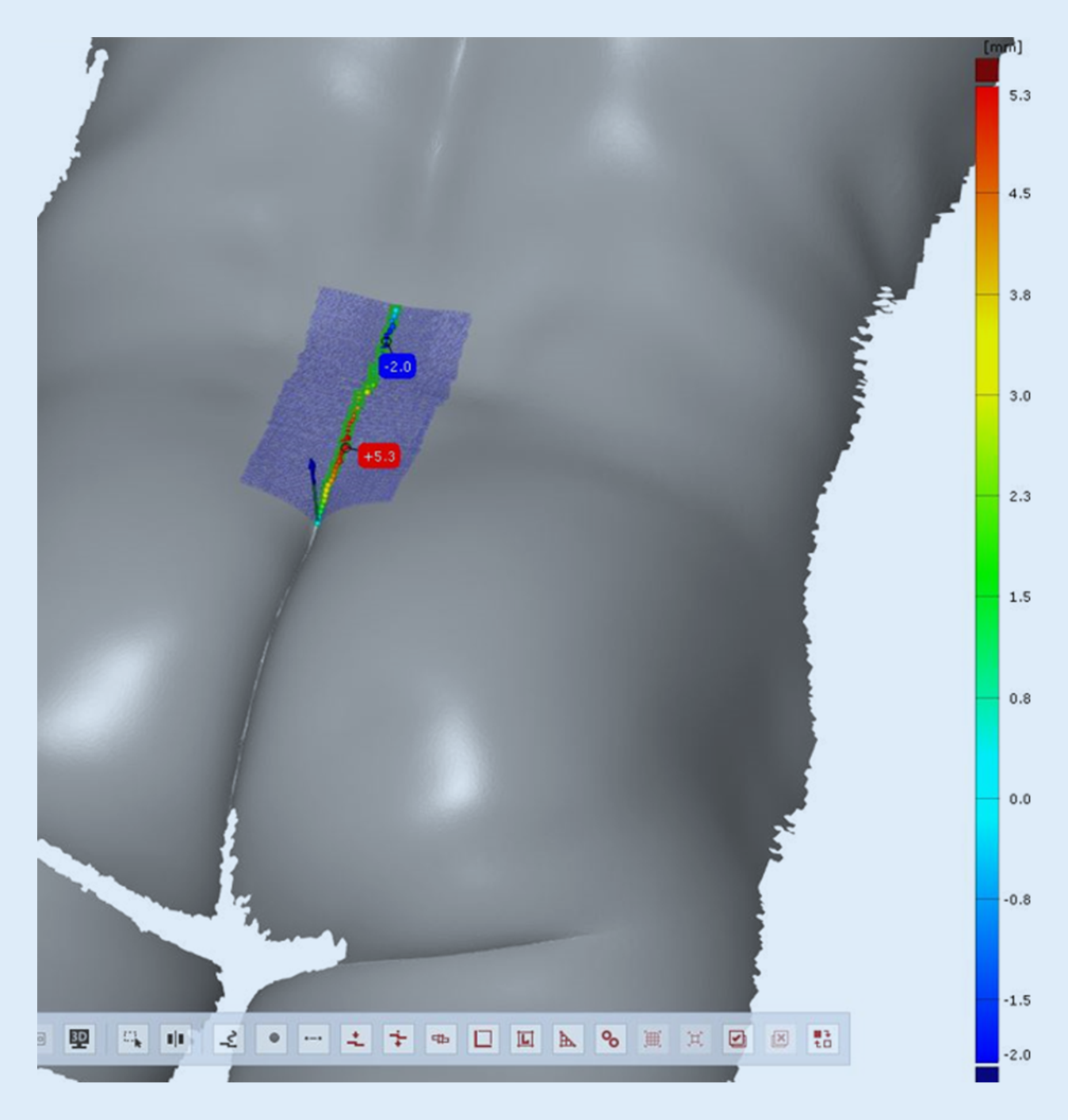 A higher glabellar soft tissue cushion is associated with a lower incidence of pilonidal sinus disease